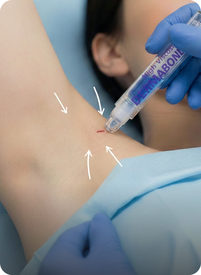 시크릿 흉터 시스템